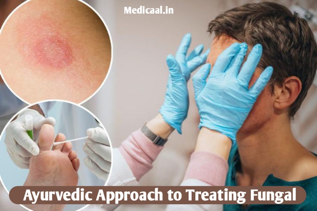 ayurvedic-approach-to-treating-fungal-infections-natural-permanent-solution
