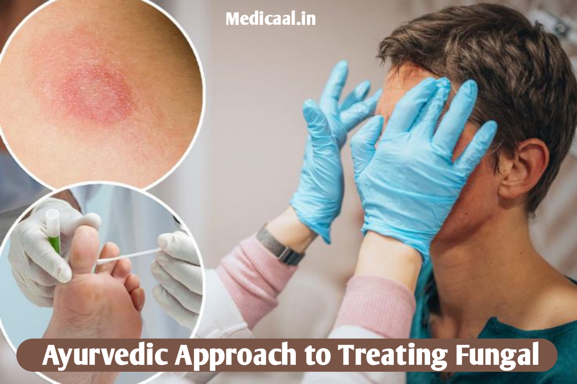 ayurvedic-approach-to-treating-fungal-infections-natural-permanent-solution